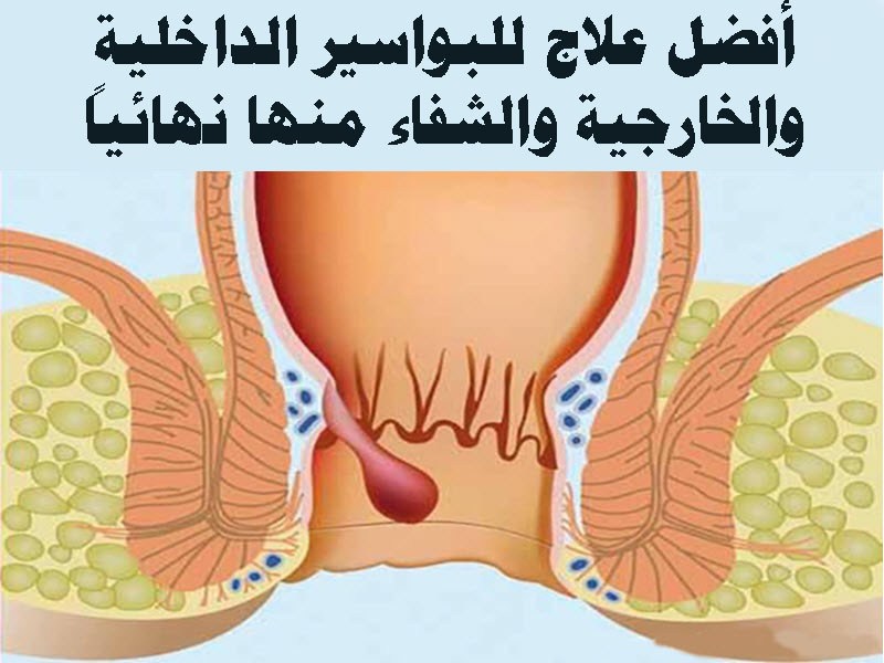 علاج البواسير 1807 3