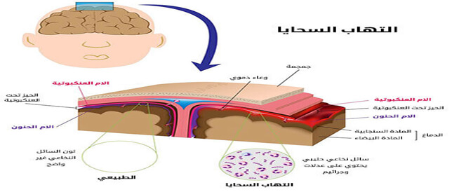 ما هو مرض السحايا , معلومات عن بعض الامراض