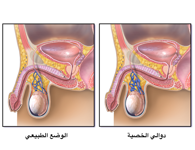 اعراض دوالي الخصيتين- اعرف اكتر عن دوالي الخصيتين 7041