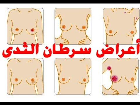 اعراض سرطان الثدي , مرض سرطان الثدي