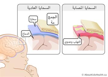 ما هو مرض السحايا- معلومات عن بعض الامراض 7107 2