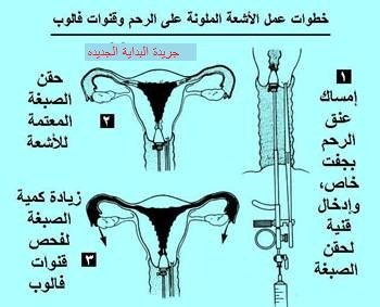 الاشعة بالصبغة على الرحم والانابيب بالصور - تصوير داخلى للرحم باستخدام الصبغة 6570 3