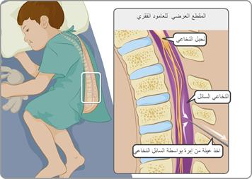 ما هو مرض السحايا- معلومات عن بعض الامراض 7107 1