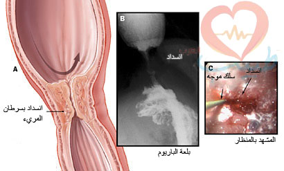 اعراض سرطان المريء - اعراض الاصابة بسرطان المريء 3676 2