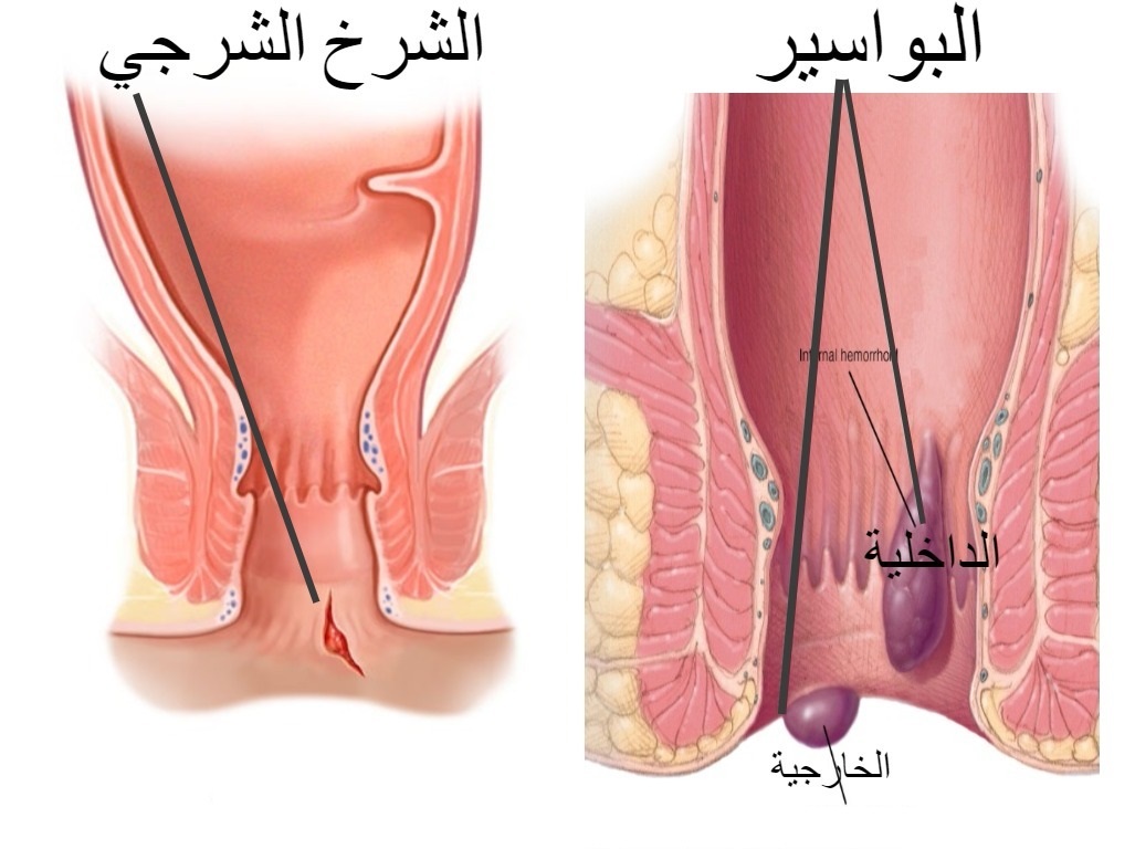 علاج البواسير 1807 1