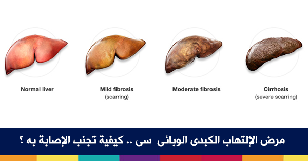 اعراض الكبد الوبائي - كيف تعرف ان الشخص مصاب بفيرس سي 7338 1