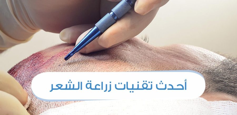 احدث تقنيات زراعة الشعر 2024 تقنية احجار الزفير , طرق سهله لزراعه الشعر