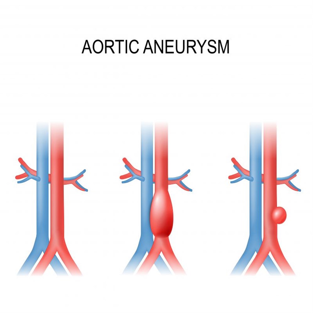 اسباب تمدد الشريان الاورطي - اعراض تمدد الاوعيه الدمويه بشريان الابهر 11796