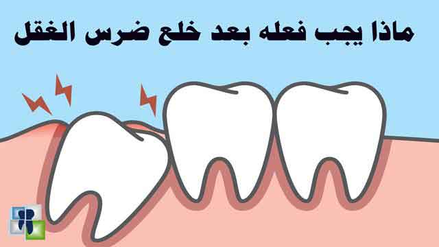 شكل ضرس العقل بعد الخلع - مشاكل خلع الاسنان 6996 1