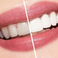 104 1 اضرار تبييض الاسنان - خطورة تبيض الاسنان بقلم التبيض او الليزر معاني علاء