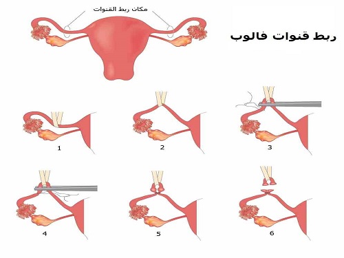 اضرار ربط قناة فالوب , هل ربط قناة فالوب بسبب تاخر الحمل