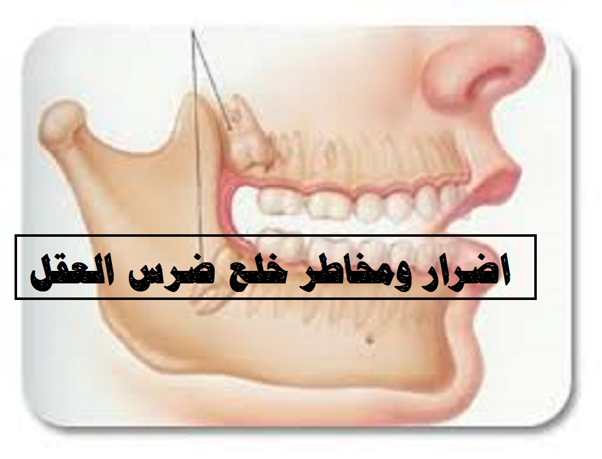 اضرار خلع ضرس العقل , مخاطر خلع ضرس العقل