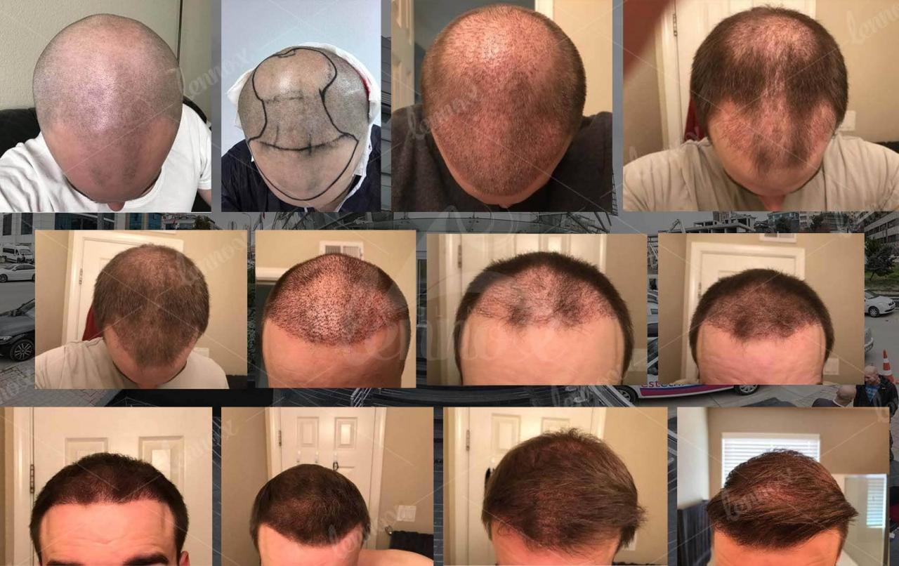 طريقة زراعة الشعر- تعرفوا على طرق زراعه الشعر 6073 1