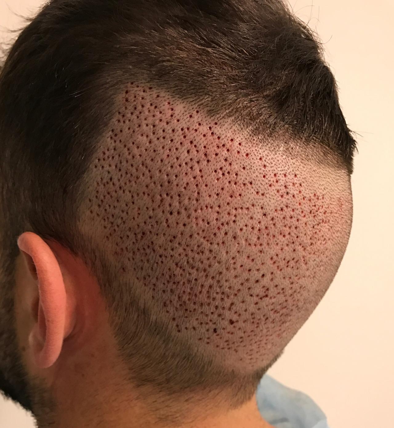 طريقة زراعة الشعر- تعرفوا على طرق زراعه الشعر 6073 2