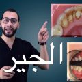 6076 3 تنظيف جير الاسنان- نظفي اسنانك باسهل الطرق معاني علاء